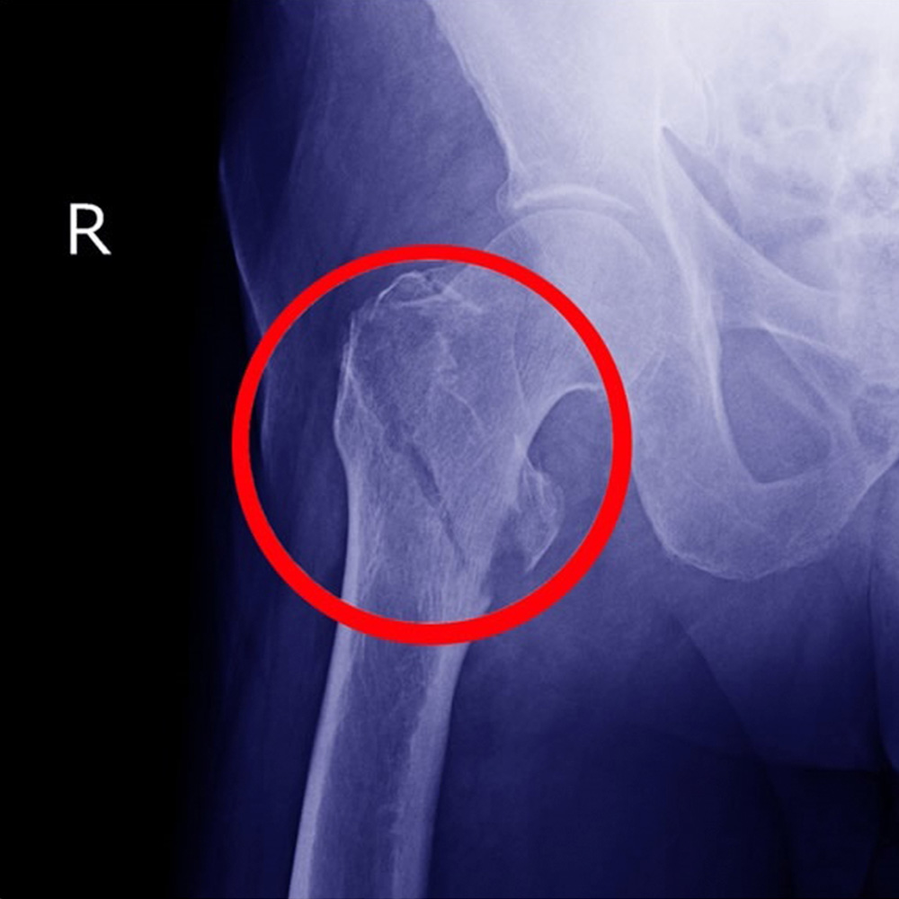 X-ray showing bad hip because of bad balance